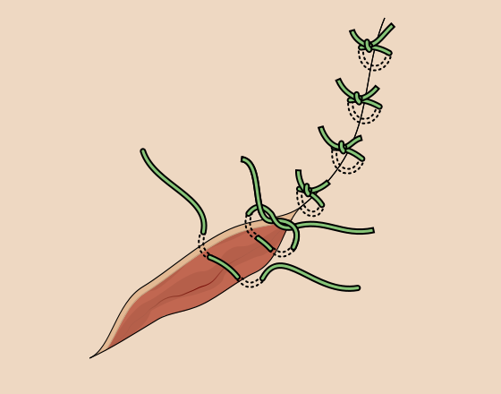 Are Smart Stitches the Next Big Medical Breakthrough?